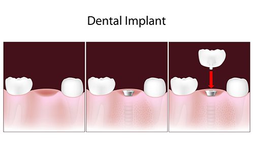 tustin dental implants