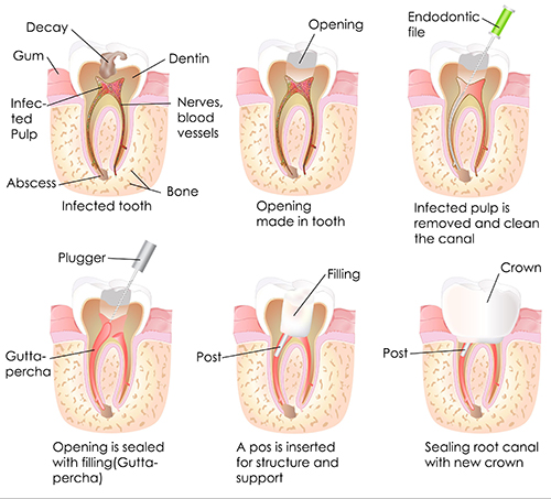 root canal in tustin